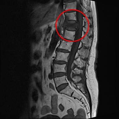 骨质疏松椎体压缩性骨折的相关诊治
